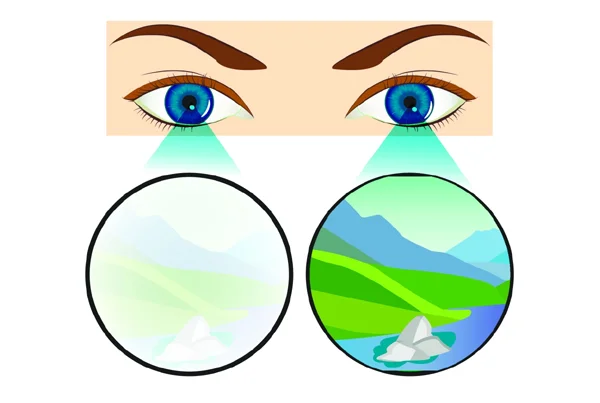Amblyopia Lazy Eye Treatment