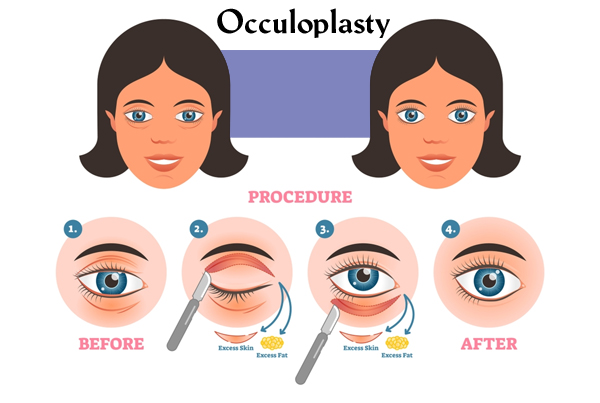 Oculoplasty Eyelid Disorders