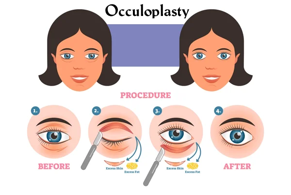 Oculoplasty Eyelid Disorders
