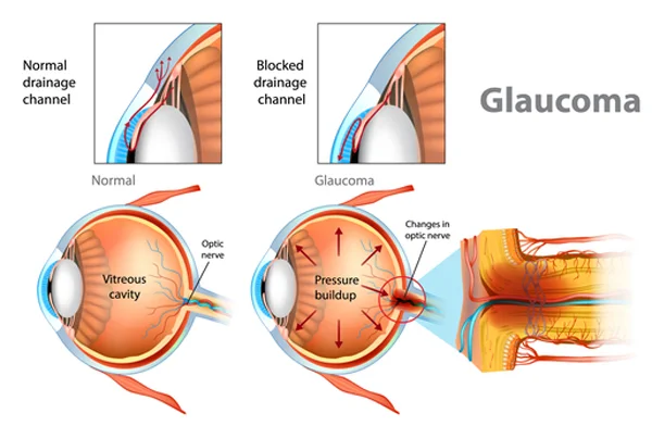 Glaucoma Surgery