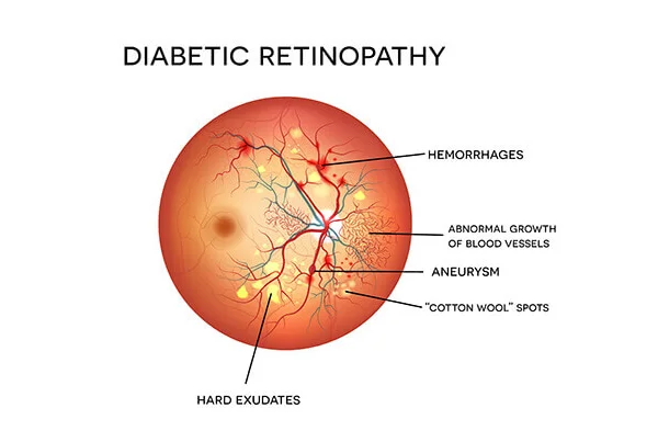Diabetic Retinopathy